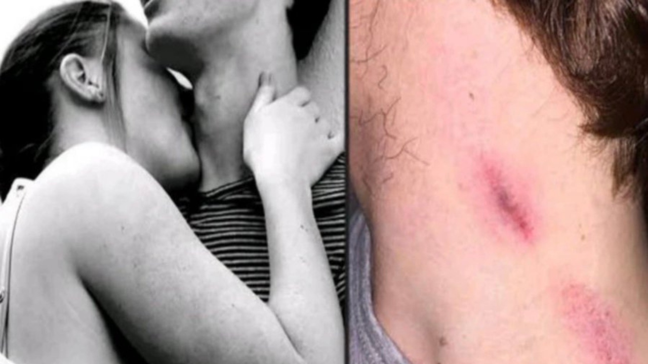 “Love Bite” එකක් තරුණයෙකුගේ ජීවිතයක් උදුරාගනී